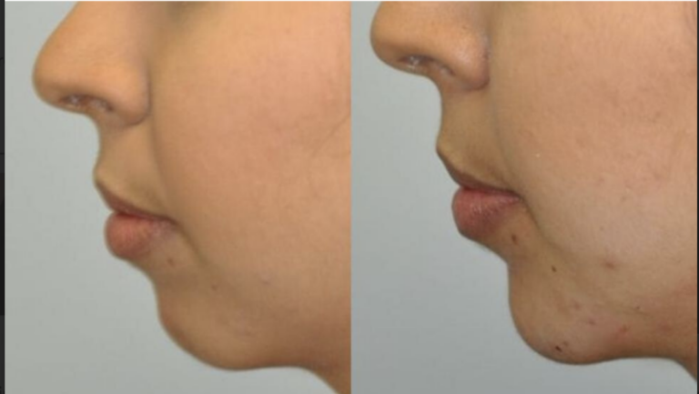 Before/after of a jawline
